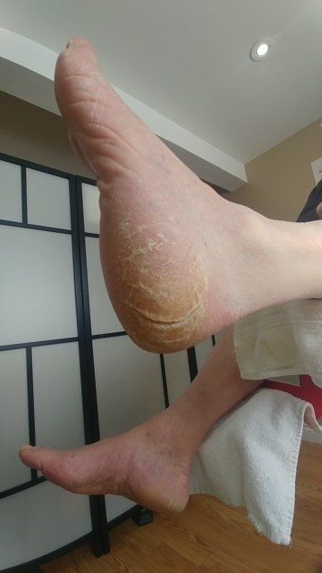 Severely hot sale cracked feet